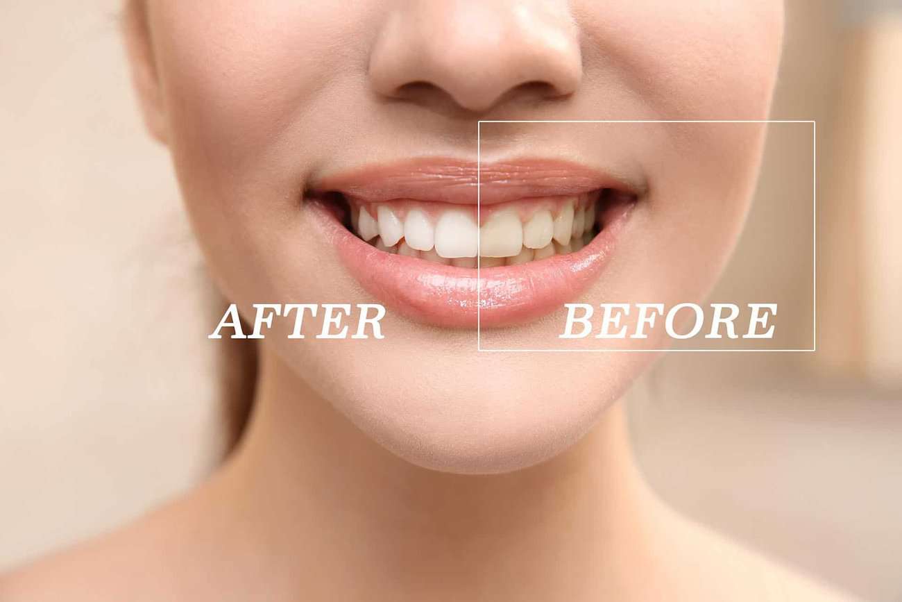 How Can You Maintain a Consistent Smile Shade with Crowns Lowestoft?