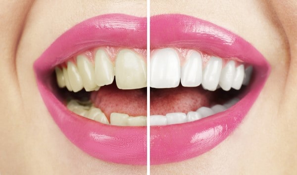 What Early Signs of Oral Cancer Should You Never Ignore Lowestoft?
