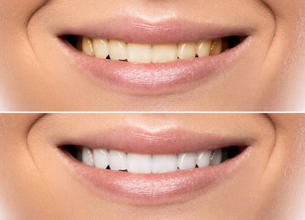 How Can You Protect Your White Smile as a Coffee Lover Lowestoft?
