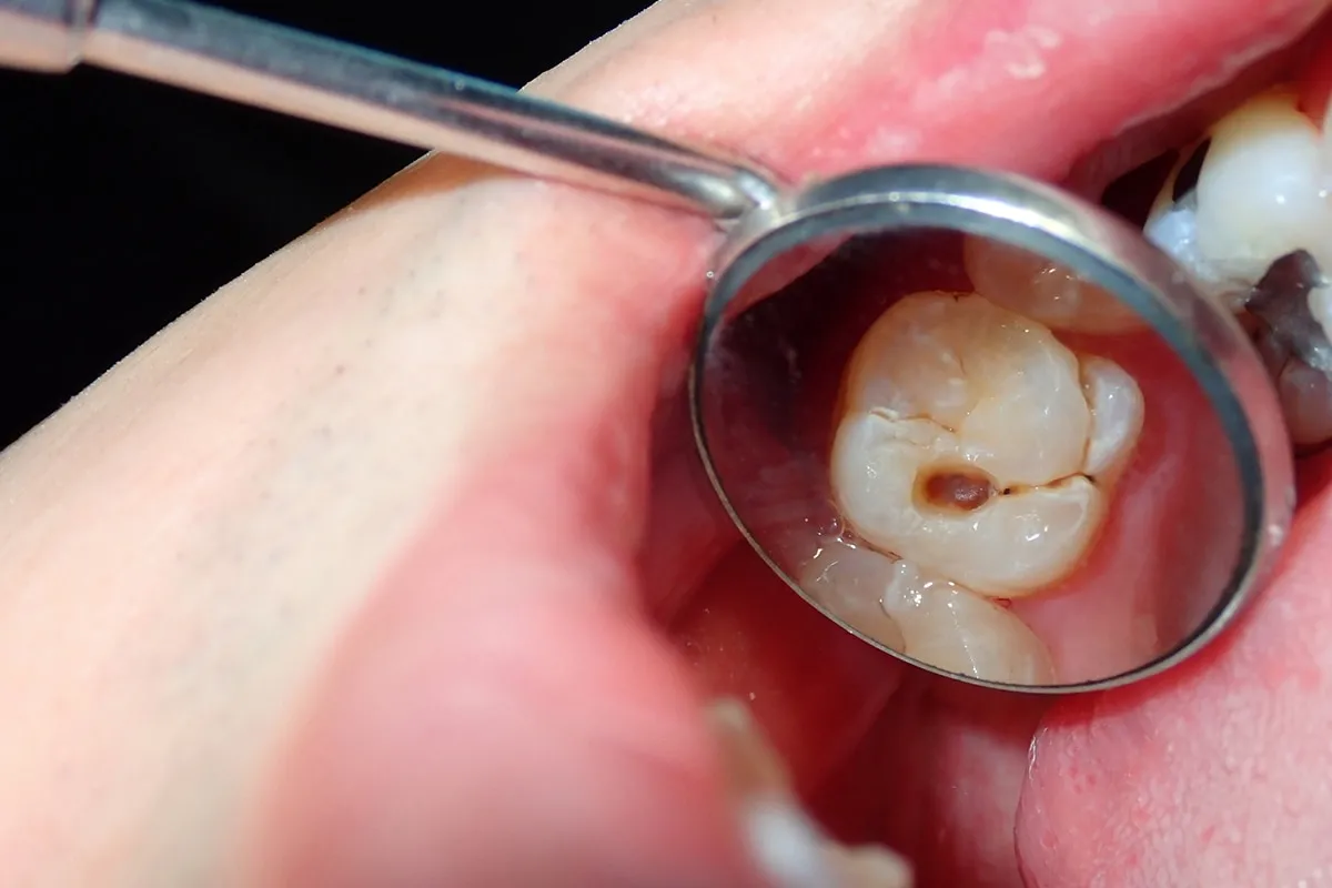 Why Do Teeth Crack? Common Causes to Know Lowestoft