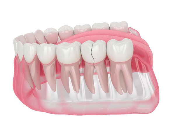 How Can You Manage Pain and Discomfort After a Root Canal Lowestoft?