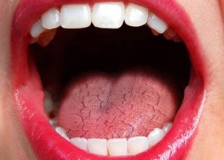 Common Causes of Dry Mouth (Xerostomia) Lowestoft