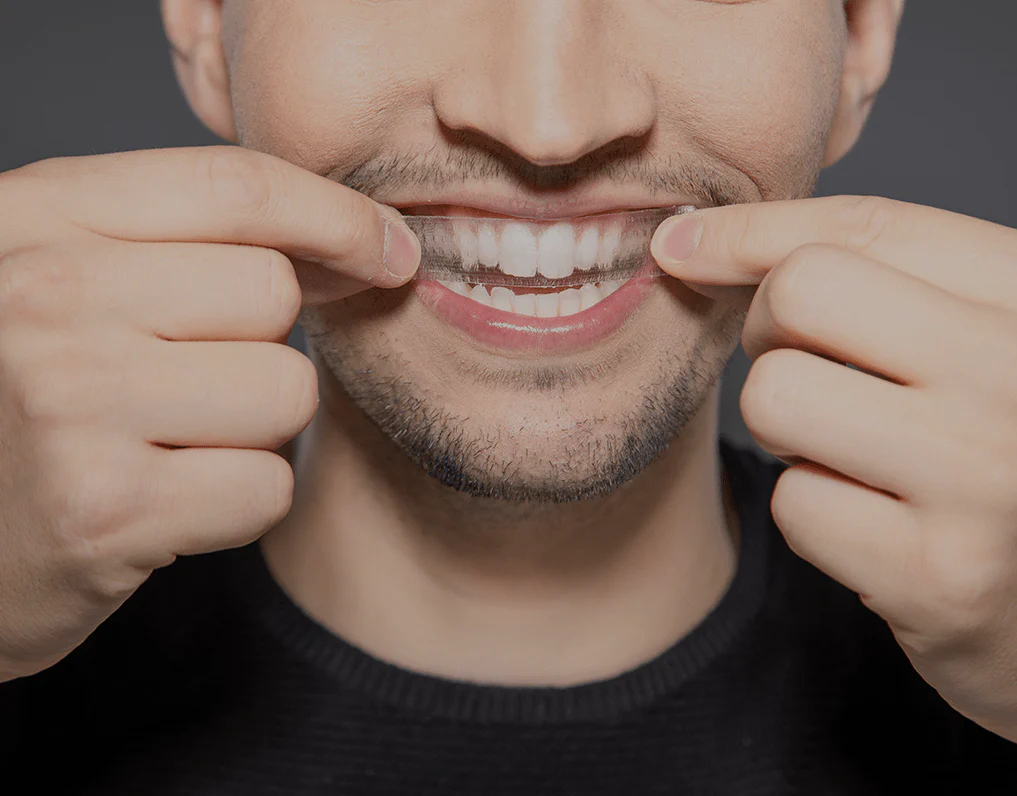 What to Consider Before Choosing a Teeth Whitening Option Lowestoft