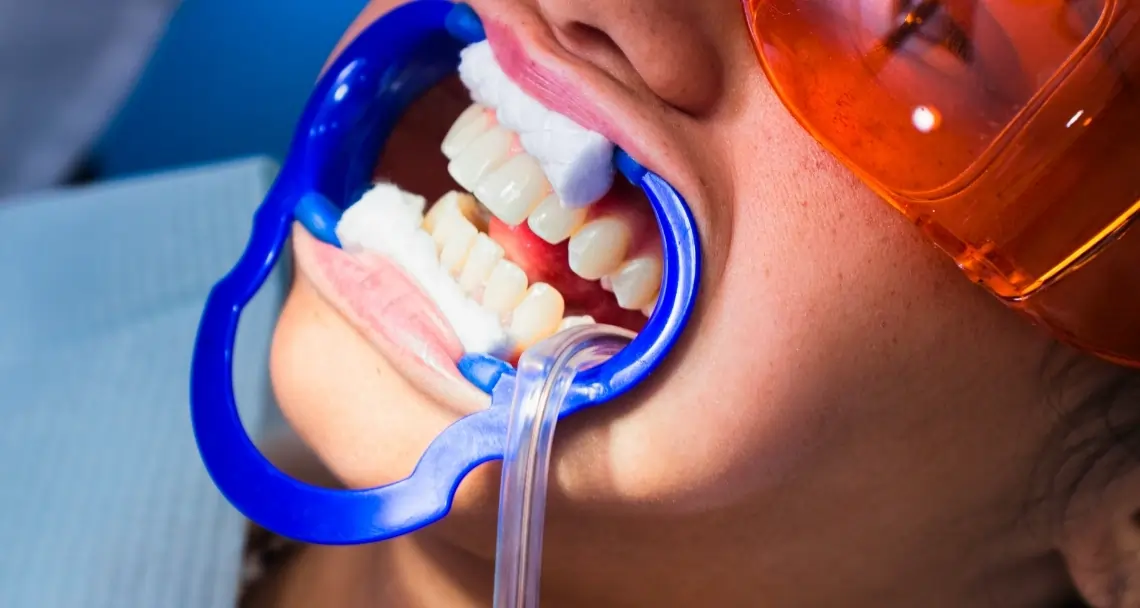What Side Effects Can You Experience After Laser Teeth Whitening Lowestoft?