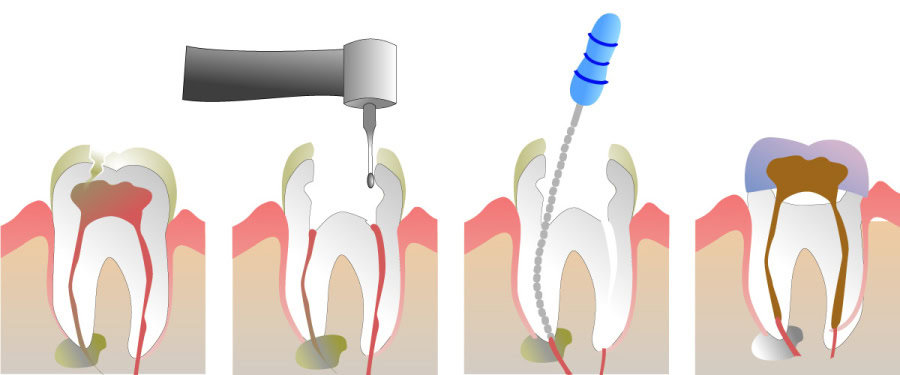 How Do You Properly Care for Your Teeth After a Root Canal Lowestoft