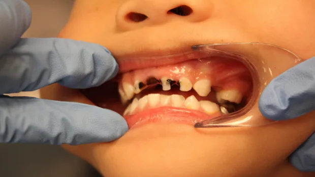 Which Foods and Drinks Cause the Most Damage to Young Smiles Lowestoft?