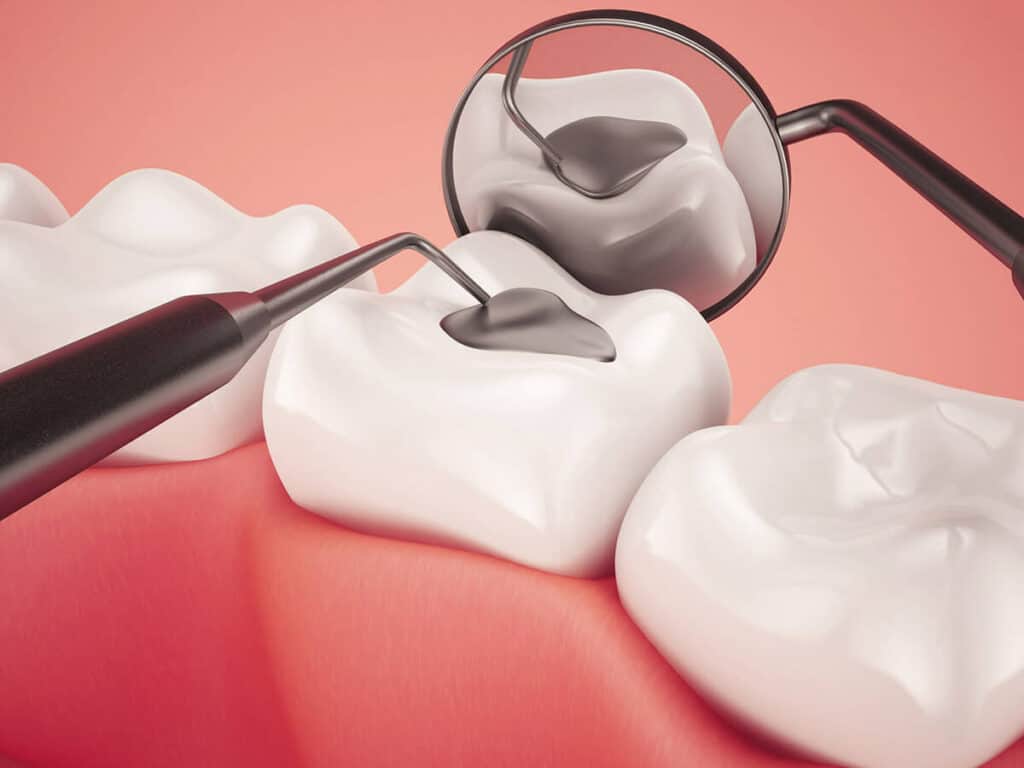 How Can You Prevent Tooth Decay Effectively Lowestoft