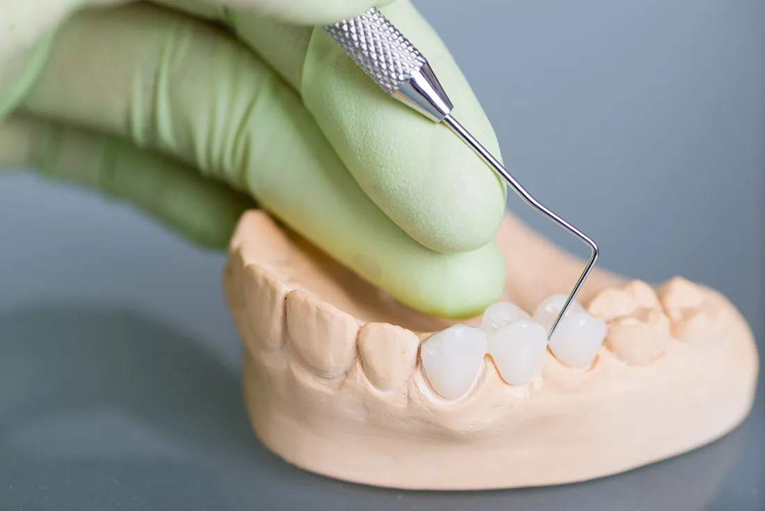 Do Braces Take Years to Show Results Lowestoft