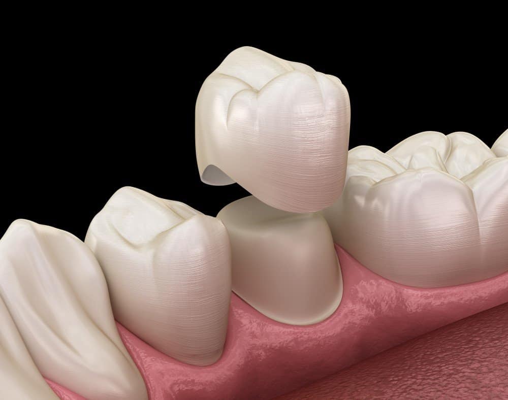 Teeth Whitening: Separating Facts from Fiction Lowestoft