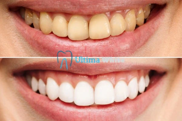 Oral Care Tips for Current and Former Smokers Lowestoft