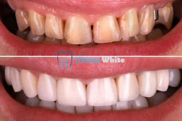 What Makes Instant Teeth Whitening Treatments So Popular Lowestoft?