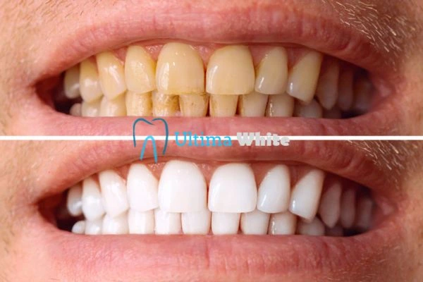 Stained Teeth and Persistent Bad Breath Lowestoft
