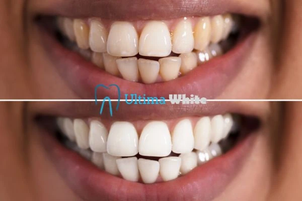 Aftercare Tips to Maintain Your New Smile Lowestoft